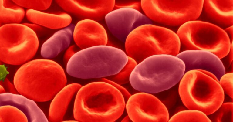 Therapy of Sickle Cells Not Linked to Most cancers, the researchers say
