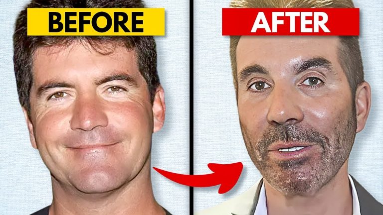 Why Is Simon Cowell’s Face Melting? His Plastic Surgery NIGHTMARE