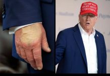 Extent of Donald Trump’s dark hand bruising revealed days after he covered it up Search Results for: Extent of Donald Trump’s dark hand bruising revealed days after he covered it up - featured image