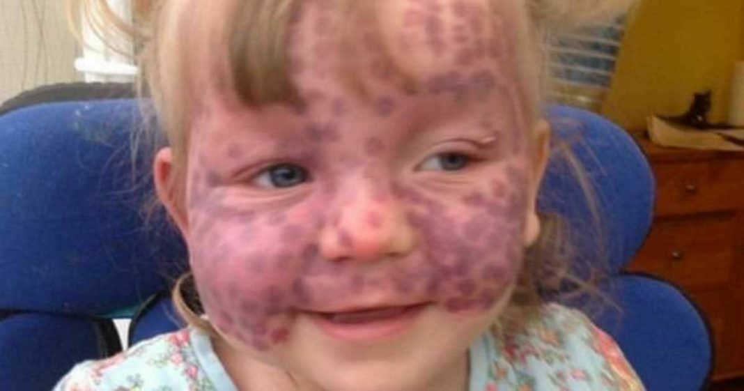 Parents respond to strangers who jump to hurtful conclusions because of their daughter’s rare skin disease - featured image