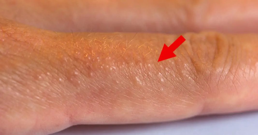 If you see these painful red bumps, you may have dyshidrotic eczema - featured image