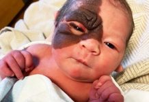 At First They Thought It’s Just A Bruise But Doctors Told Them About The Diagnosis At First They Thought It’s Just A Bruise But Doctors Told Them About The Diagnosis - featured image