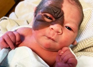 At First They Thought It’s Just A Bruise But Doctors Told Them About The Diagnosis At First They Thought It’s Just A Bruise But Doctors Told Them About The Diagnosis - featured image