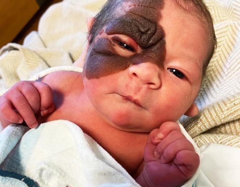 At First They Thought It’s Just A Bruise But Doctors Told Them About The Diagnosis - featured image At First They Thought It’s Just A Bruise But Doctors Told Them About The Diagnosis - featured image
