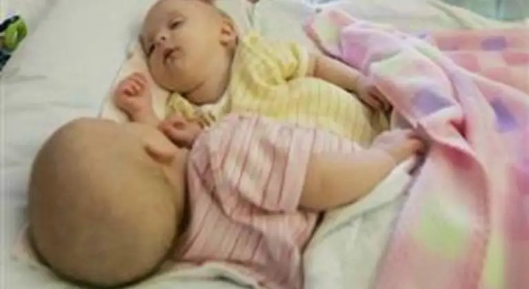 Conjoined Twins Bella And Abby Were Genuinely Associated From Birth, Yet Medical Procedure Changed Everything - featured image Conjoined Twins Bella And Abby Were Genuinely Associated From Birth, Yet Medical Procedure Changed Everything - featured image