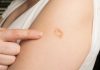 Smallpox vaccine scars: What they look like and why Smallpox vaccine scars: What they look like and why - featured image