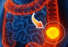 Woman reveals 5 colon cancer symptoms that shouldn’t be ignored Woman reveals 5 colon cancer symptoms that shouldn’t be ignored - featured image