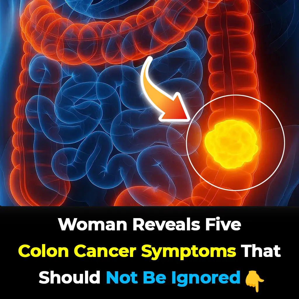 Woman reveals 5 colon cancer symptoms that shouldn’t be ignored - featured image Woman reveals 5 colon cancer symptoms that shouldn’t be ignored - featured image