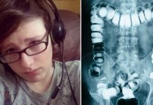 Doctors diagnose teen with constipation, dies 24 hours later Doctors diagnose teen with constipation, dies 24 hours later - featured image