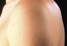 Here’s The Truth Behind This Scar On People’s Upper Left Arm Here’s The Truth Behind This Scar On People’s Upper Left Arm - featured image