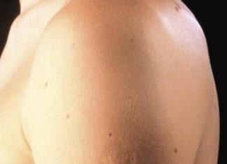 Here’s The Truth Behind This Scar On People’s Upper Left Arm Here’s The Truth Behind This Scar On People’s Upper Left Arm - featured image