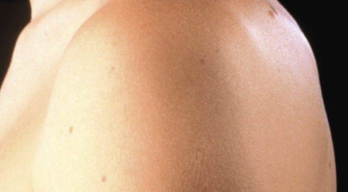 Here’s The Truth Behind This Scar On People’s Upper Left Arm Here’s The Truth Behind This Scar On People’s Upper Left Arm - featured image