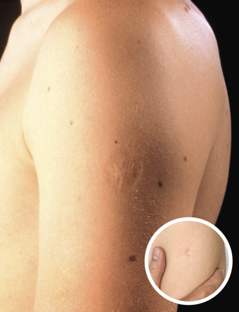Here’s The Truth Behind This Scar On People’s Upper Left Arm - featured image Here’s The Truth Behind This Scar On People’s Upper Left Arm - featured image