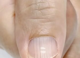 If you have these lines on your nails after 40, it is a clear sign that.. If you have these lines on your nails after 40, it is a clear sign that.. - featured image