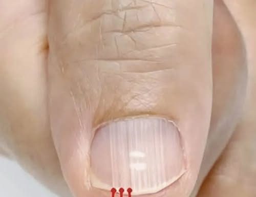 If you have these lines on your nails after 40, it is a clear sign that.. If you have these lines on your nails after 40, it is a clear sign that.. - featured image