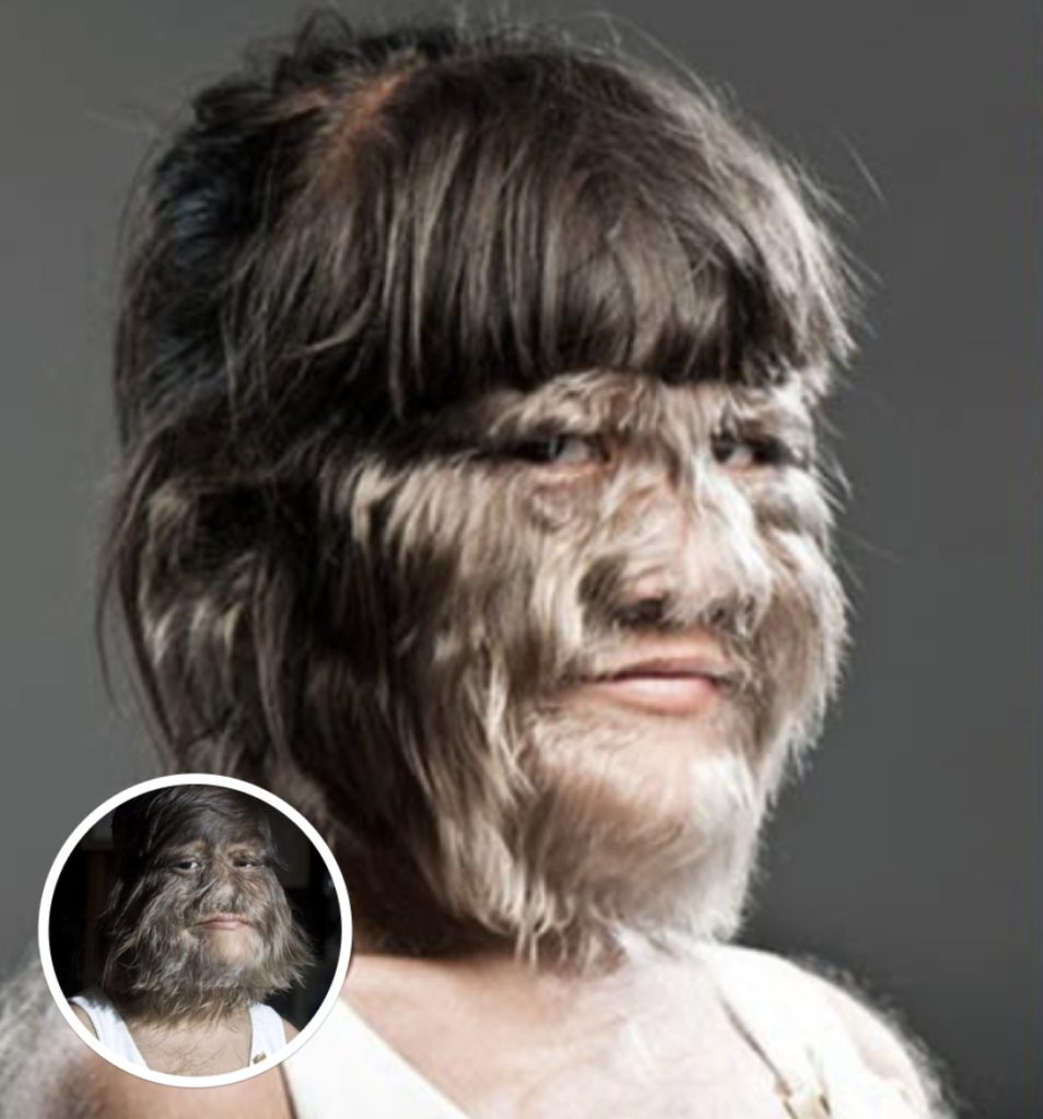 World’s ‘Hairiest Girl’ Shaves It All Off After Meeting Her Soulmate, Here’s How She Looks After - featured image World’s ‘Hairiest Girl’ Shaves It All Off After Meeting Her Soulmate, Here’s How She Looks After - featured image