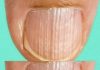What It Means When You Notice Ridges on Your Fingernails What It Means When You Notice Ridges on Your Fingernails - featured image