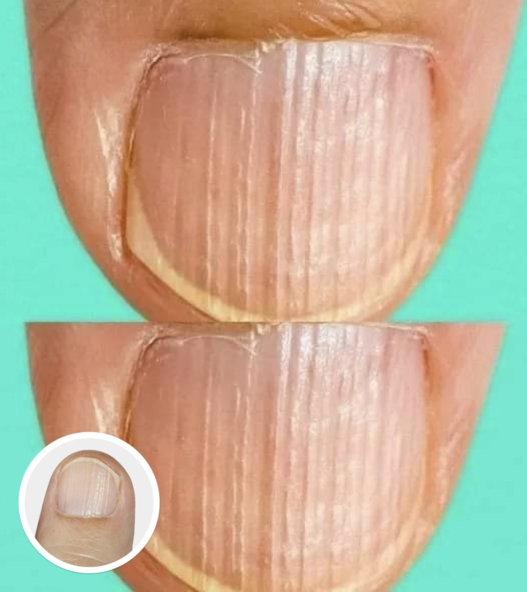 What It Means When You Notice Ridges on Your Fingernails - featured image What It Means When You Notice Ridges on Your Fingernails - featured image
