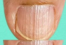 What It Means When You Notice Ridges on Your Fingernails What It Means When You Notice Ridges on Your Fingernails - featured image
