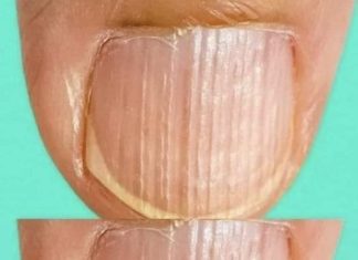What It Means When You Notice Ridges on Your Fingernails What It Means When You Notice Ridges on Your Fingernails - featured image