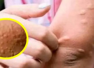 His whole body was itchy, he thought it was an allergy but then he was diagnosed His whole body was itchy, he thought it was an allergy but then he was diagnosed - featured image