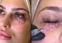 Doctor Warns Against Dangerous Trend That Leaves People Looking Like ‘Reptiles’ Doctor Warns Against Dangerous Trend That Leaves People Looking Like ‘Reptiles’ - featured image