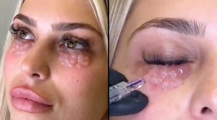 Doctor Warns Against Dangerous Trend That Leaves People Looking Like ‘Reptiles’ Doctor Warns Against Dangerous Trend That Leaves People Looking Like ‘Reptiles’ - featured image