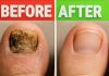 Home Remedy for Toenail Fungus: Before and After Home Remedy for Toenail Fungus: Before and After - featured image