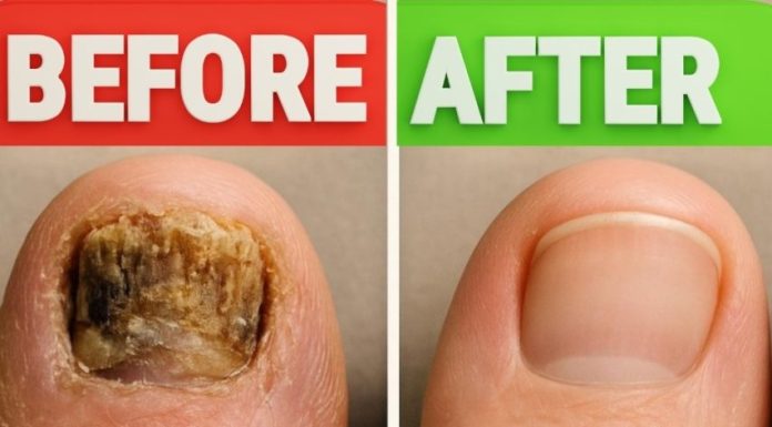 Home Remedy for Toenail Fungus: Before and After Home Remedy for Toenail Fungus: Before and After - featured image