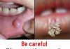 Be very careful if it comes out in your mouth, you are infected Be very careful if it comes out in your mouth, you are infected - featured image