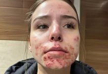 The Hidden Reasons You Keep Getting Pimples on Your Chin The Hidden Reasons You Keep Getting Pimples on Your Chin - featured image