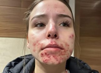 The Hidden Reasons You Keep Getting Pimples on Your Chin The Hidden Reasons You Keep Getting Pimples on Your Chin - featured image