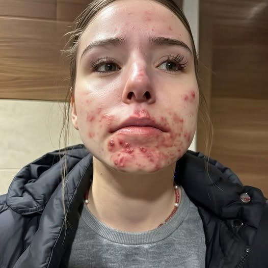 The Hidden Reasons You Keep Getting Pimples on Your Chin - featured image The Hidden Reasons You Keep Getting Pimples on Your Chin - featured image