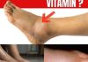 The No.1 Vitamin for Removing Leg and Foot Swelling! The No.1 Vitamin for Removing Leg and Foot Swelling! - featured image
