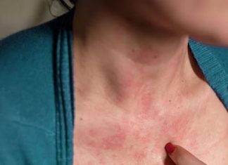 Doctor has message for anyone who gets ‘itchy bo.o.bs’ Doctor has message for anyone who gets ‘itchy bo.o.bs’ - featured image