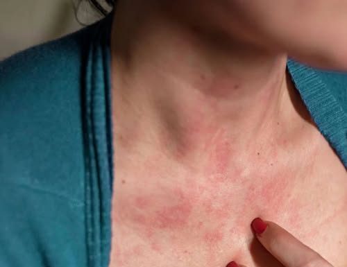 Doctor has message for anyone who gets ‘itchy bo.o.bs’ Doctor has message for anyone who gets ‘itchy bo.o.bs’ - featured image