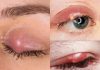 How to treat a painful stye at home in days How to treat a painful stye at home in days - featured image