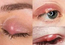 How to treat a painful stye at home in days How to treat a painful stye at home in days - featured image