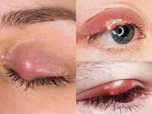 How to treat a painful stye at home in days How to treat a painful stye at home in days - featured image
