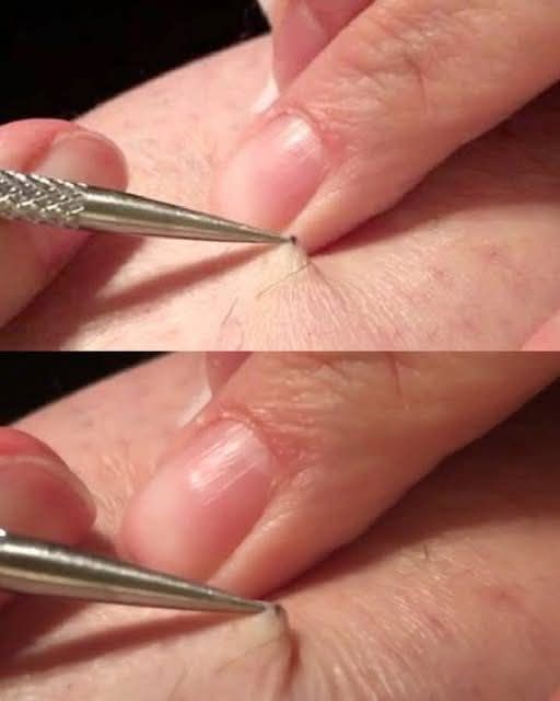 A man discovered a black spot on his leg and began to peel it off. What he removed left millions speechless. - featured image A man discovered a black spot on his leg and began to peel it off. What he removed left millions speechless. - featured image