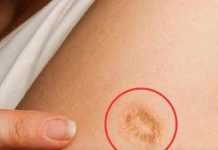5 Common Misconceptions About the Round Scar on the Upper Arm 5 Common Misconceptions About the Round Scar on the Upper Arm - featured image