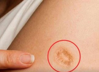 5 Common Misconceptions About the Round Scar on the Upper Arm 5 Common Misconceptions About the Round Scar on the Upper Arm - featured image