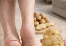 Just One Potato Can Help Soften Cracked Heels and Ease Discomfort Just One Potato Can Help Soften Cracked Heels and Ease Discomfort - featured image
