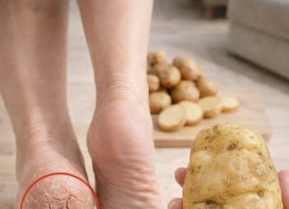 Just One Potato Can Help Soften Cracked Heels and Ease Discomfort Just One Potato Can Help Soften Cracked Heels and Ease Discomfort - featured image