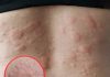 His whole body was itchy, he thought it was an allergy and was diagnosed His whole body was itchy, he thought it was an allergy and was diagnosed - featured image