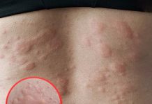 His whole body was itchy, he thought it was an allergy and was diagnosed His whole body was itchy, he thought it was an allergy and was diagnosed - featured image