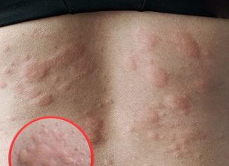 His whole body was itchy, he thought it was an allergy and was diagnosed His whole body was itchy, he thought it was an allergy and was diagnosed - featured image