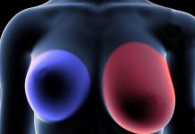 Breast cancer: 4 early signs every woman should know. Breast cancer: 4 early signs every woman should know. - featured image