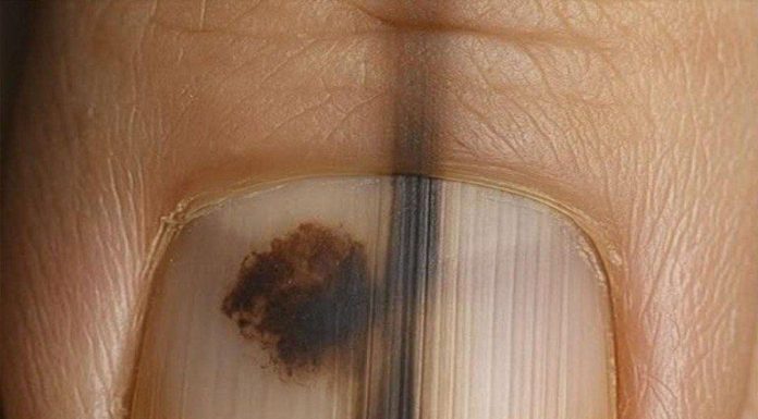 This is not a bruise: it is one of the most aggressive skin tumors, and many people mistakenly consider it a simple bump. This is not a bruise: it is one of the most aggressive skin tumors, and many people mistakenly consider it a simple bump. - featured image