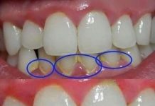 Remove dental plaque in 5 minutes naturally, without going to the dentist. Remove dental plaque in 5 minutes naturally, without going to the dentist. - featured image